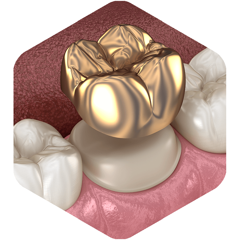 A 3D illustration of a gold crown being placed.
